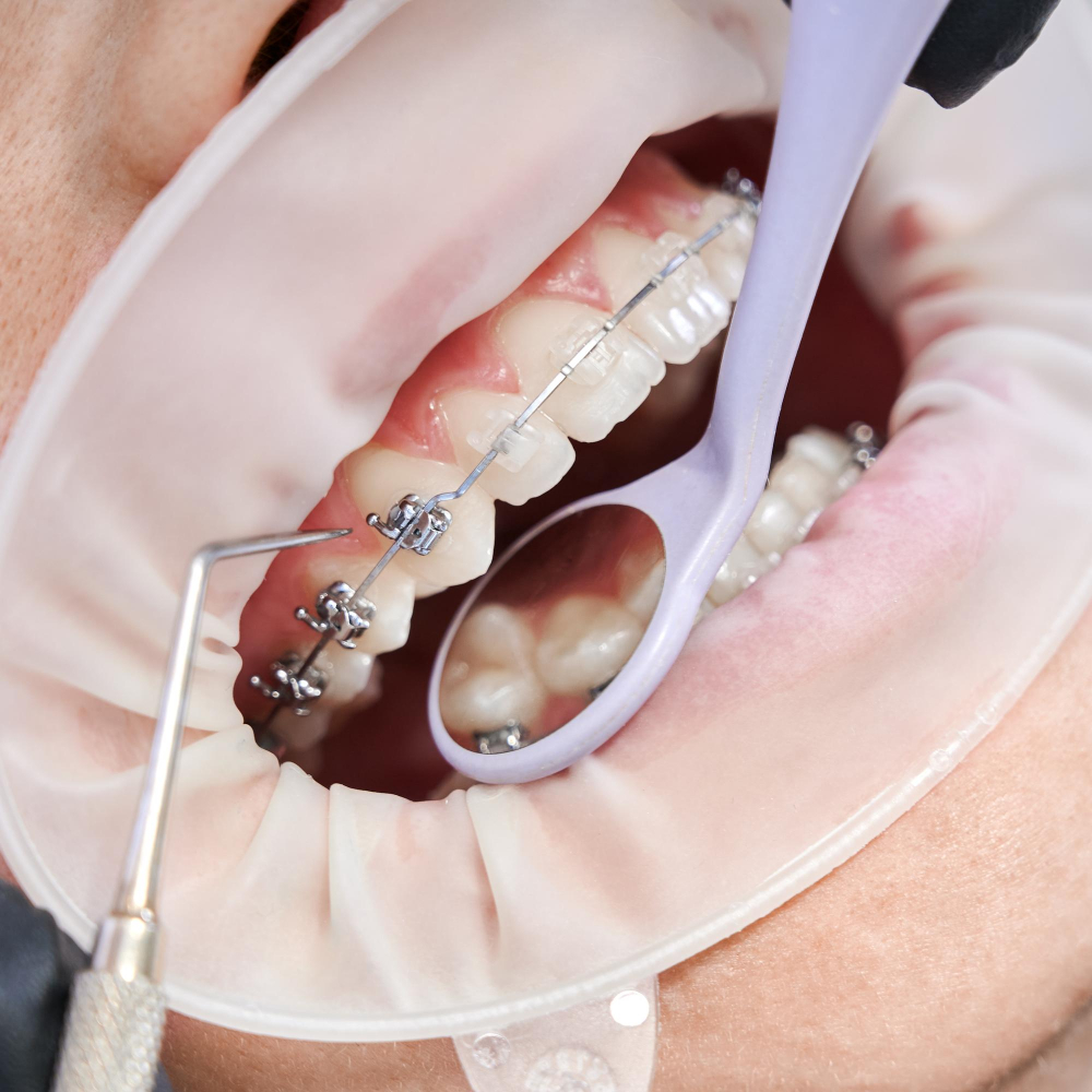 Orthodontic clips & wire treatment